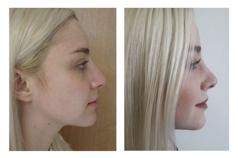 Rhinoplasty in Mexico Galvan Plastic Surgery Institute